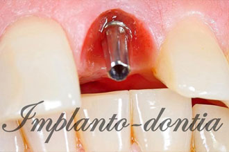 single teeth implants