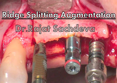 Ridge splitting for lateral ridge Augmentation