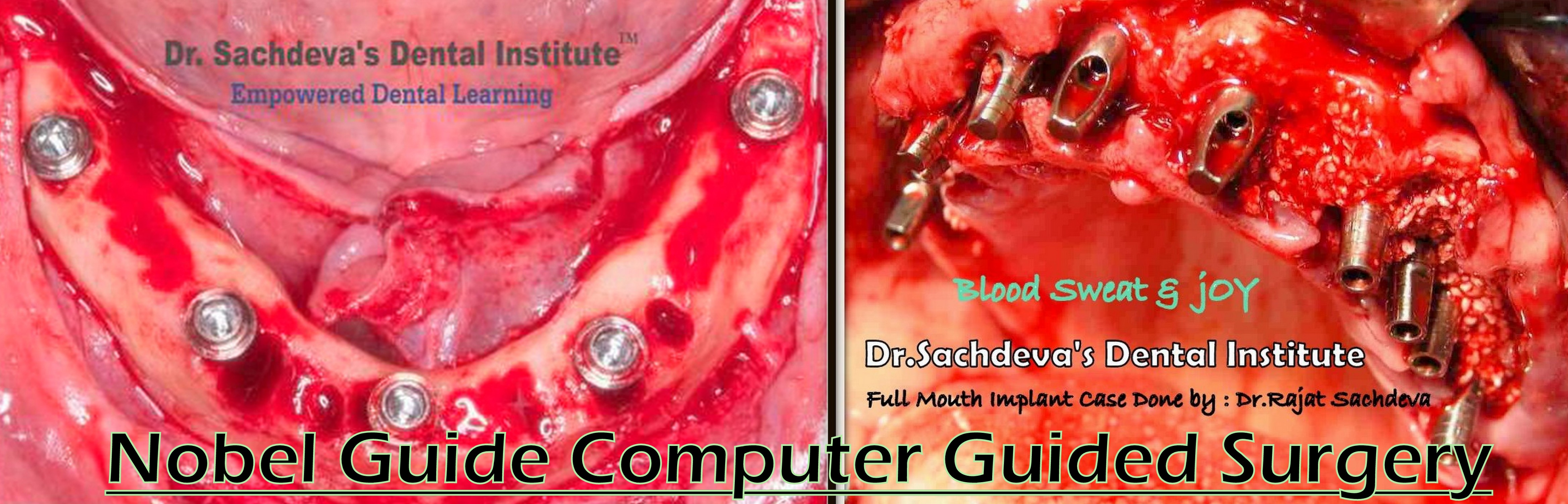 Nobel Guide Computer Guided Surgery