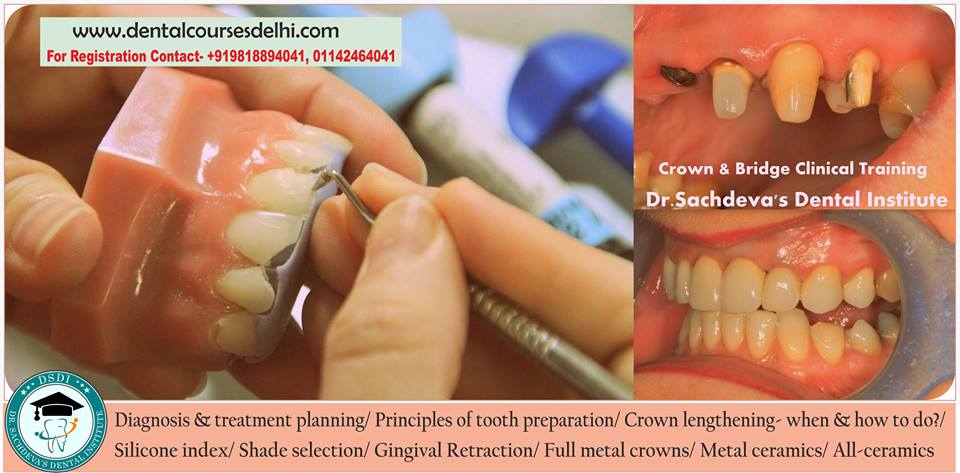 Dental Crown Bridges Veneers